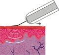 TUA_SPA_ULTRASUONI_LAMA_IN_SCIVOLAMENTO