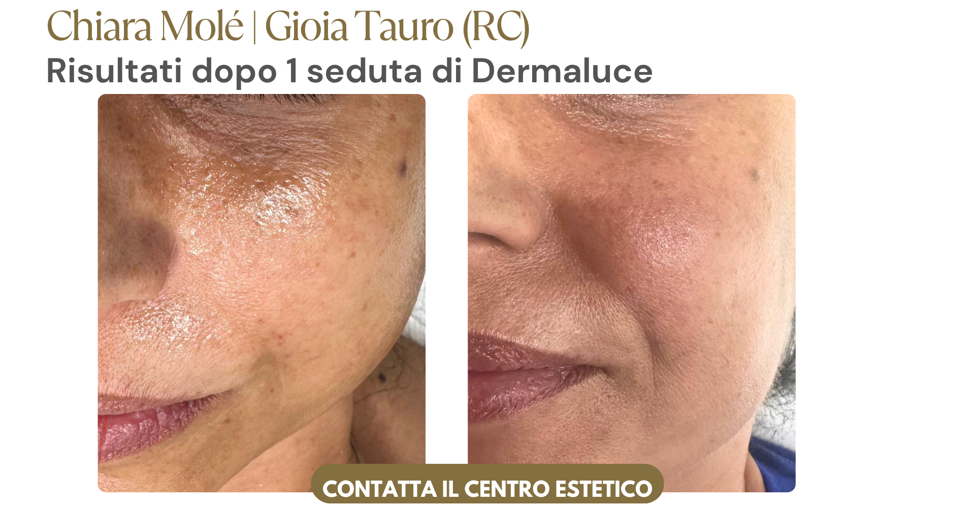 Risultati dopo 1 seduta di Dermagenesi