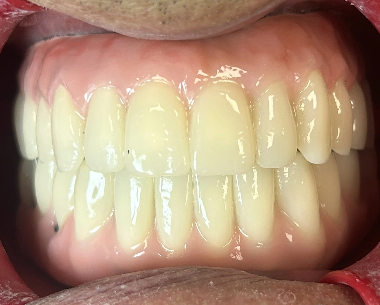 Protesi tipo Toronto Bridge su impianti