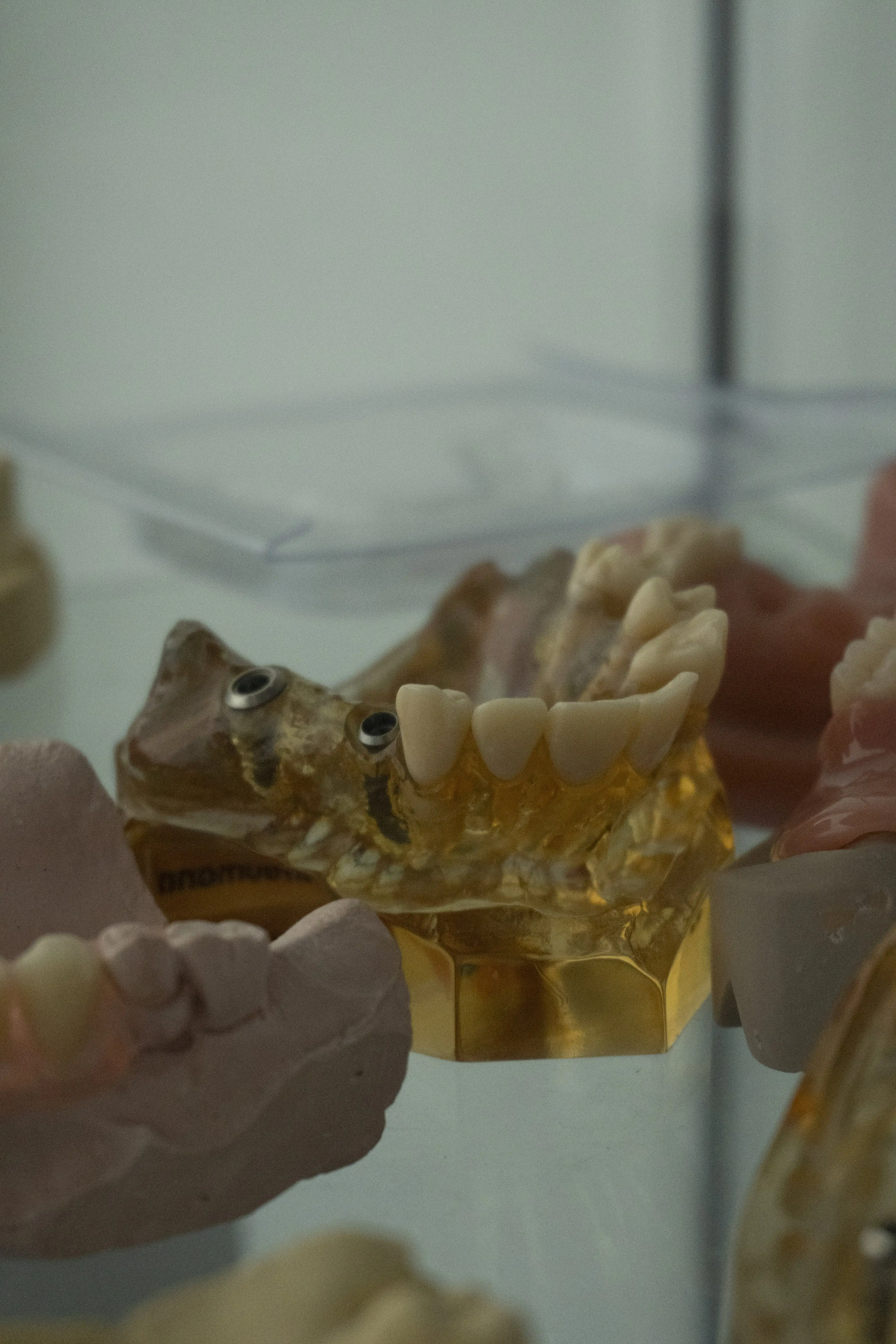 Protesi fisse su impianti dentali