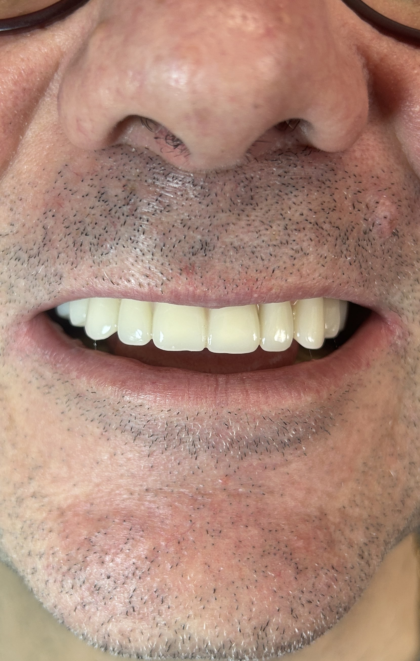 Ponti dentali su impianti