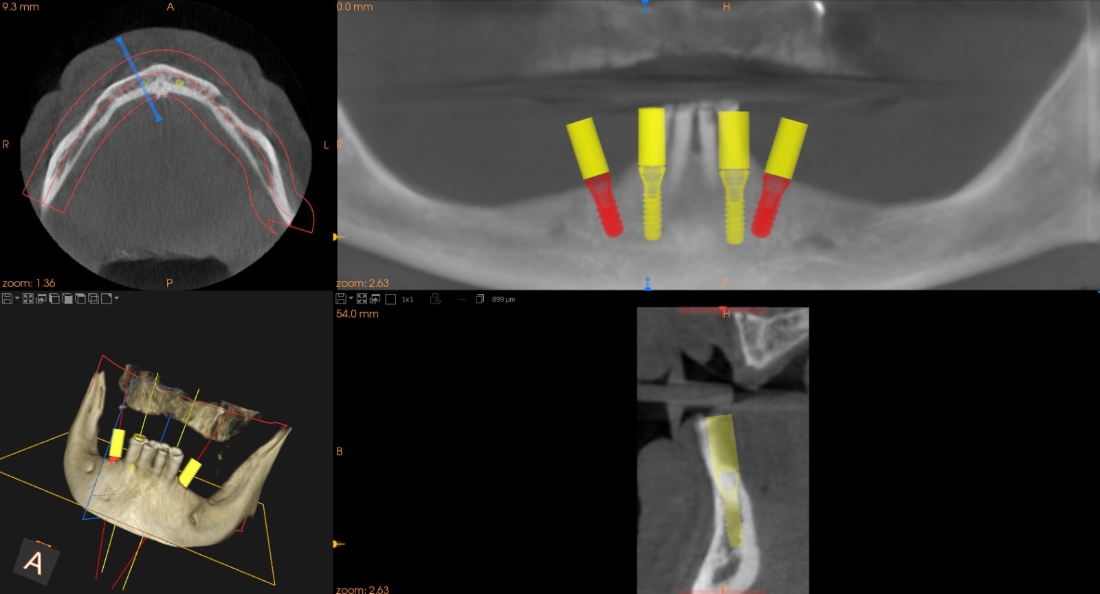 TAC Cone Beam 3D Odontoiatria San Paolo