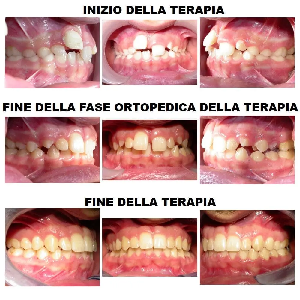 Esempi di terapia ortodontica
