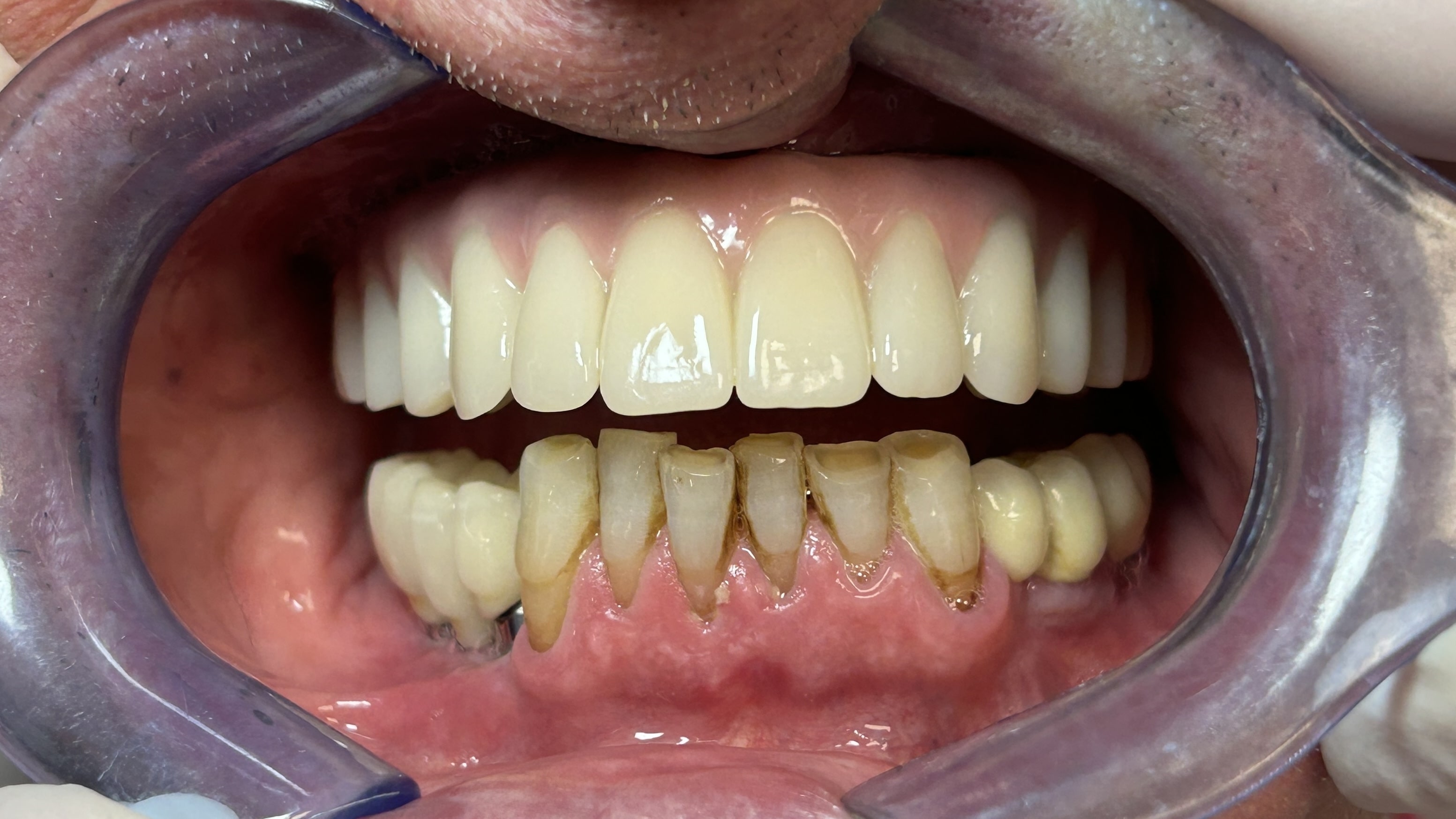 Ponti dentali su impianti