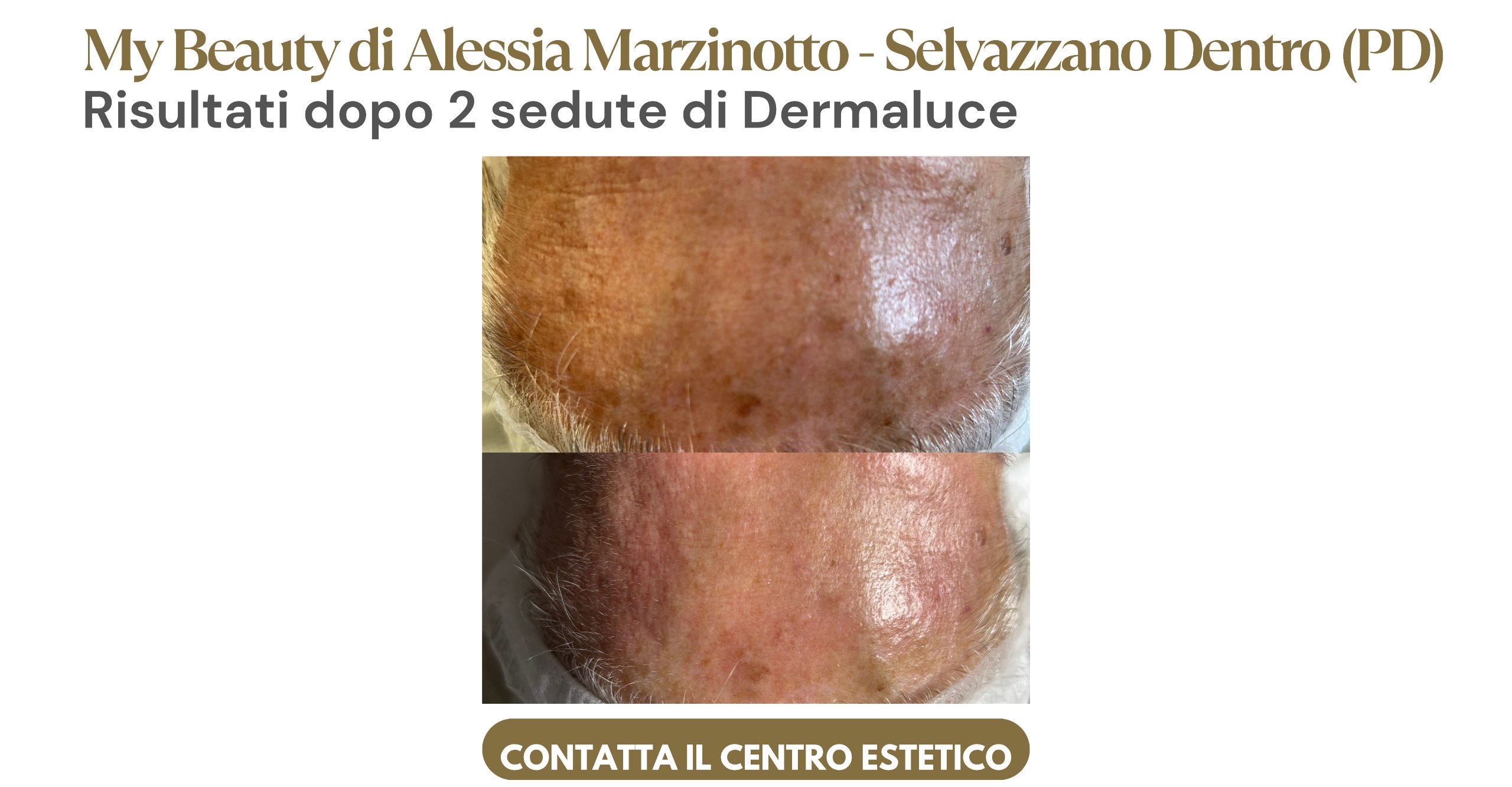 Risultati dopo 1 seduta di Dermagenesi
