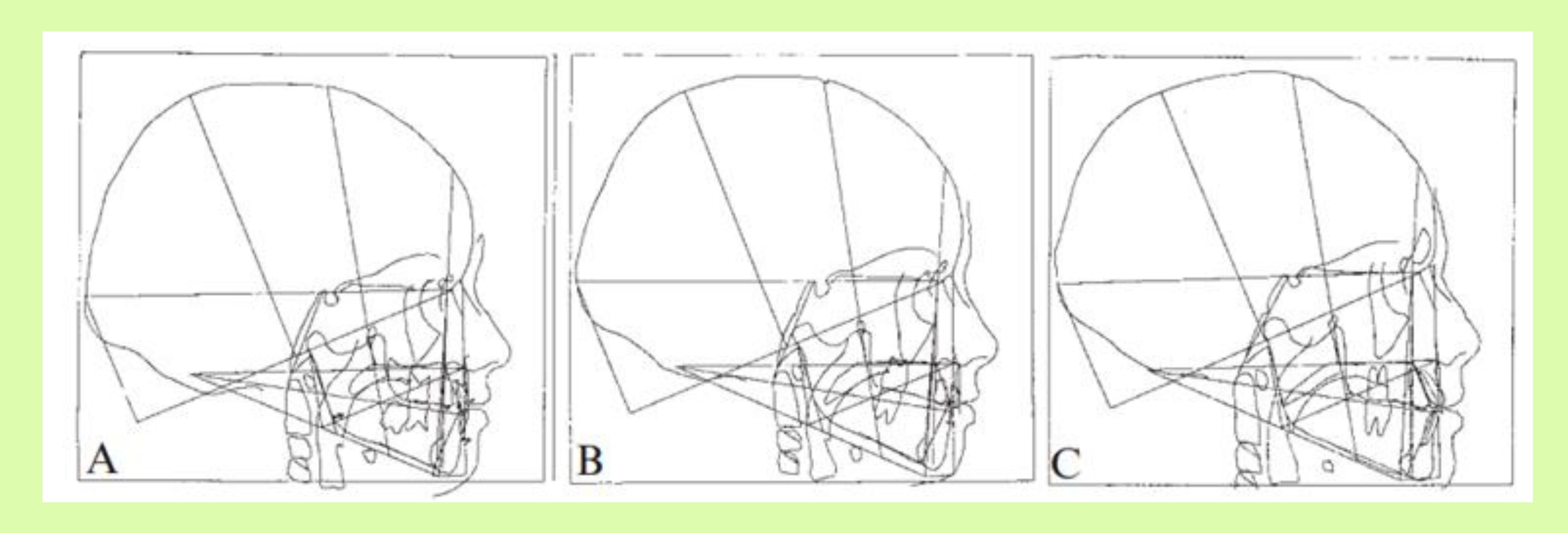 malocclusione di 3 classe
