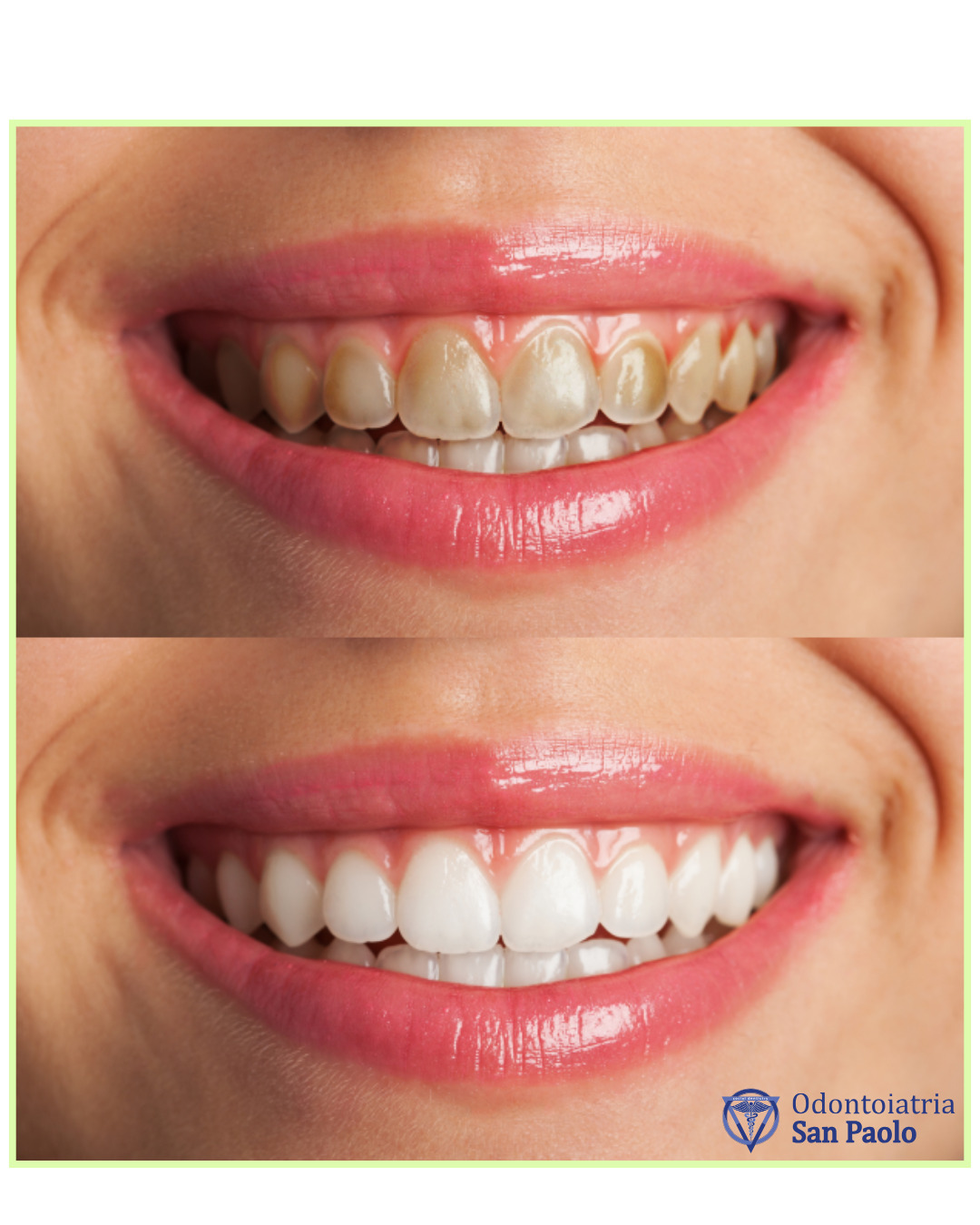 Denti neri: tutte le cause e rimedi