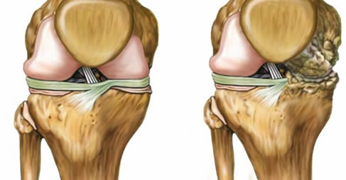 cartilagine ginocchio consumata